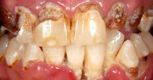 Meth Mouth Images 5 Mouth with tooth decay from meth