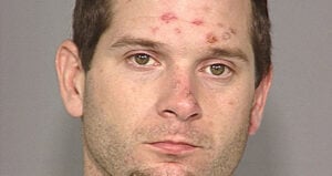 Meth sores on face