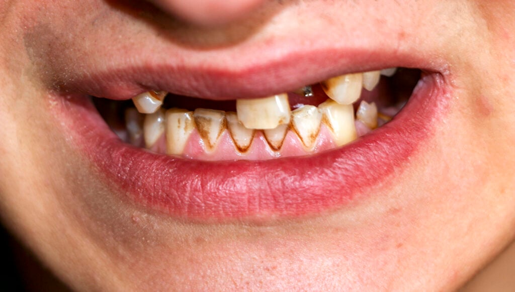 Meth Mouth Images 3 Depositphotos 342788814 XL