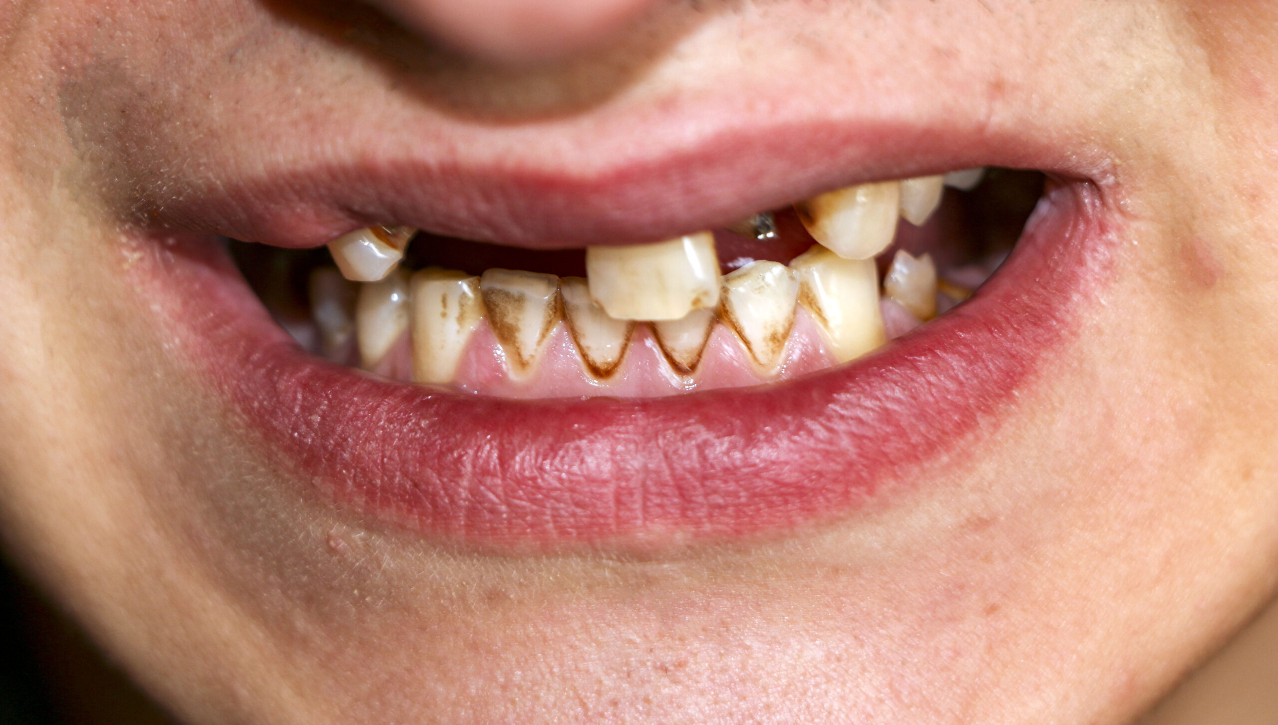 Meth Mouth: What It Looks Like and How to Treat It